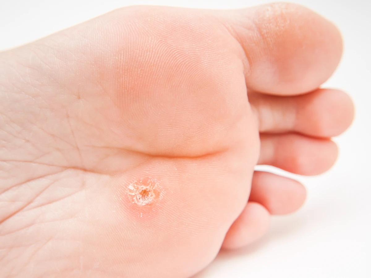 Ile kosztuje usunięcie kurzajki u dermatologa?