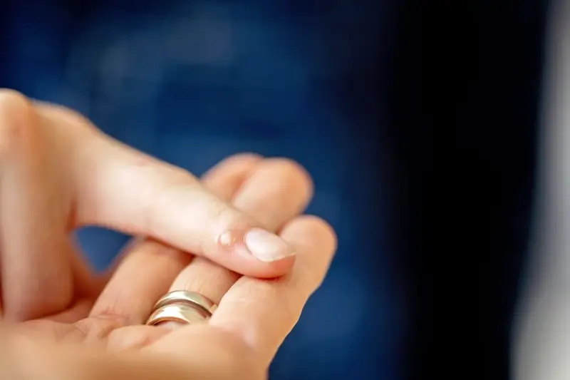 Od czego powstają kurzajki na dłoniach